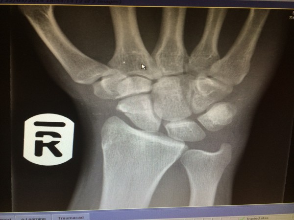 Andrew Burdett's X-ray showing the broken scaphoid in his hand.